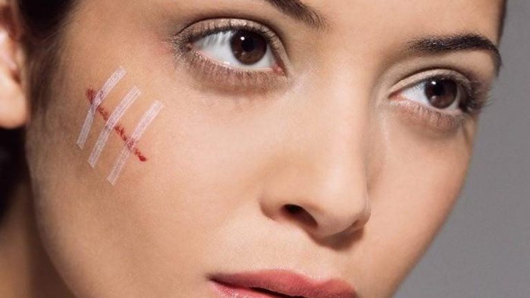 Tırnak izleri nasıl kaldırılır?  Yüzdeki ve ciltteki tırnak izleri nasıl kaldırılır?