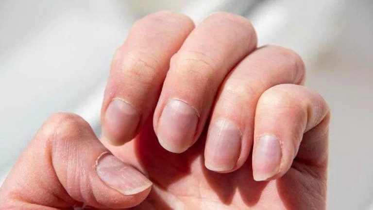 Tırnakların sağlığına ilişkin haberler … Hangi doktor çiviye gidebilir? Tırnak hastalıklarına hangi bölüme bakar?