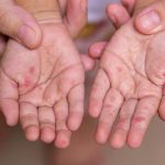 El Ayak Hastalığı Belirtileri Nelerdir? El Ayak Hastalığı Nasıl Anlaşılır? Tedavi Yöntemleri Nelerdir?