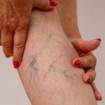 Varikosel Nedir, Beliritleri Nelerdir? Varikosel Tedavisi Nasıl Yapılır?