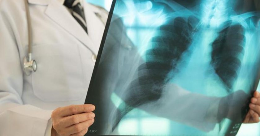 Erken tanı hayati önem taşıyor! Akciğer kanserinin belirtileri ne? Öksürük, göğüs ağrısı, halsizlik, kanlı balgam… –